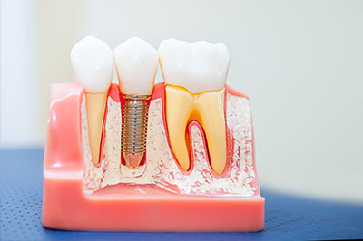 William L. Krell, DDS, MAGD | Crowns, Air Abrasion and Dental Fillings