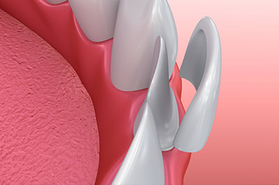 William L. Krell, DDS, MAGD | Ceramic Crowns, CEREC and Laser Dentistry