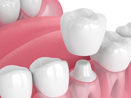 William L. Krell, DDS, MAGD | Invisalign reg , Night Guards and Air Abrasion