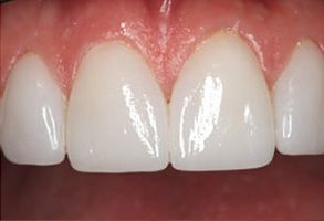 William L. Krell, DDS, MAGD | Ceramic Crowns, Fluoride Treatment and Preventative Program