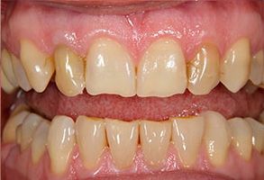 William L. Krell, DDS, MAGD | Air Abrasion, Full Mouth Reconstruction and Preventative Program