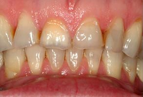 William L. Krell, DDS, MAGD | Full Mouth Reconstruction, Digital Impressions and Invisalign reg 