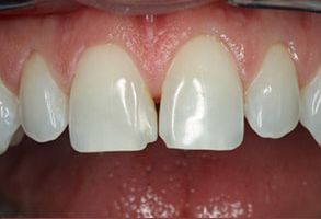 William L. Krell, DDS, MAGD | Oral Cancer Screening, Fluoride Treatment and Implant Restorations